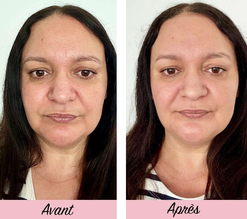 Avant / après masque led visage Currentbody